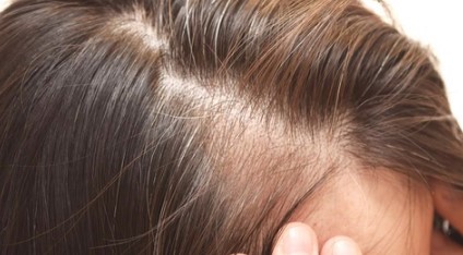 Apakah Vitamin A Baik untuk Rambut yang Mengalami Penipisan?