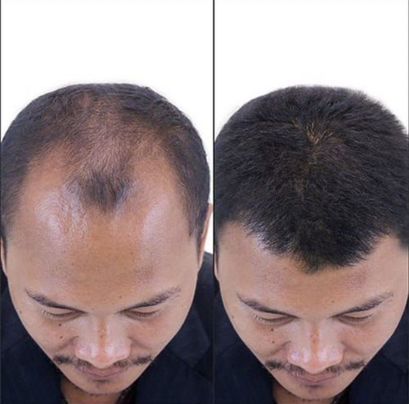 Cara Cepat Tumbuh Rambut: Teknik dan Produk untuk Mempercepat Pertumbuhan Rambut