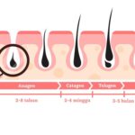 Rambut Rontok, Pertanda Diabetes?