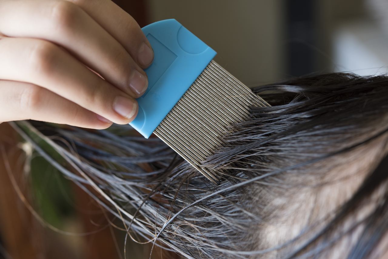 Kutu Rambut Bikin Jengkel? Atasi dengan Baking Soda!