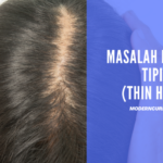 Rambut Rontok Tak Terkendali? Waspadai Masalah Tiroid!