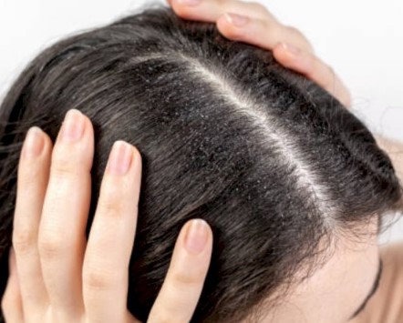 Selamat Tinggal Ketombe: Rahasia Mengatasi Rambut Berketombe Secara Alami