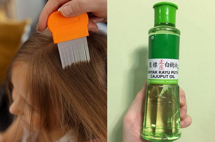 Atasi Kutu Rambut dengan Minyak Tea Tree: Cara Alami yang Efektif!