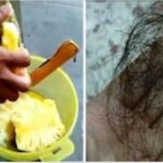 Rambut Rontok Akibat Ketombe? Atasi Dengan 7 Solusi Efektif Ini!