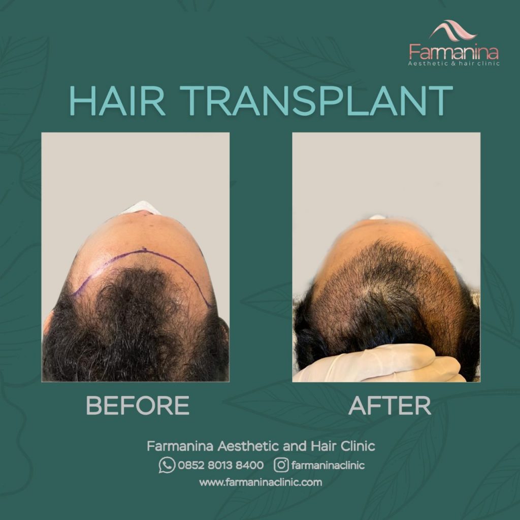 Kehilangan Rambut? Transplantasi Rambut Bisa Jadi Solusinya!