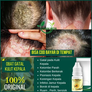 Kulit Kepala Gatal Hati-hati, Produk Rambut Bisa Jadi Biang Keladinya!