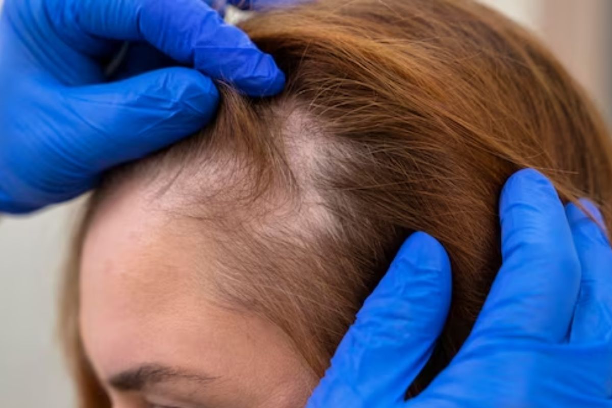 Apakah Rambut yang Botak Bisa Tumbuh Kembali? Sebuah Panduan Lengkap