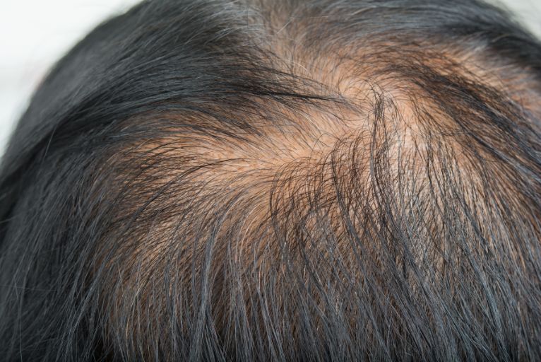 Rambut Rontok Turun Temurun? Jangan Panik! Simak Tips Mengatasi Kebotakan Akibat Genetik