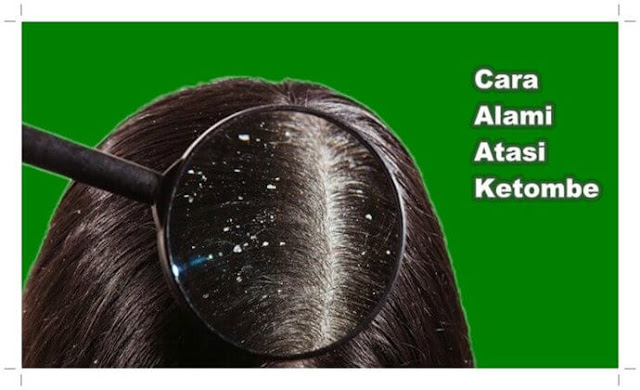 Selamat Tinggal Ketombe: Rahasia Mengatasi Rambut Berketombe Secara Alami