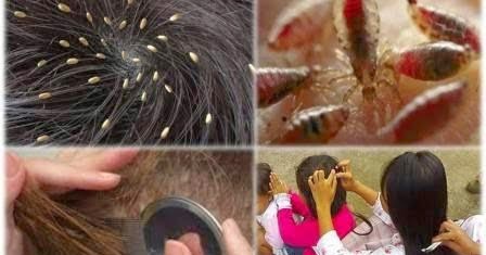 Bagaimana Bisa Ada Kutu di Rambut? Misteri yang Sering Bikin Gatal!