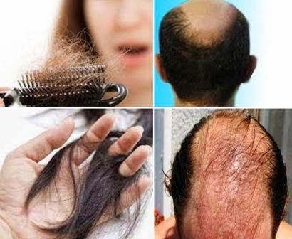 Rambut Rontok: Mengapa Hal Itu Terjadi dan Bagaimana Mengatasinya