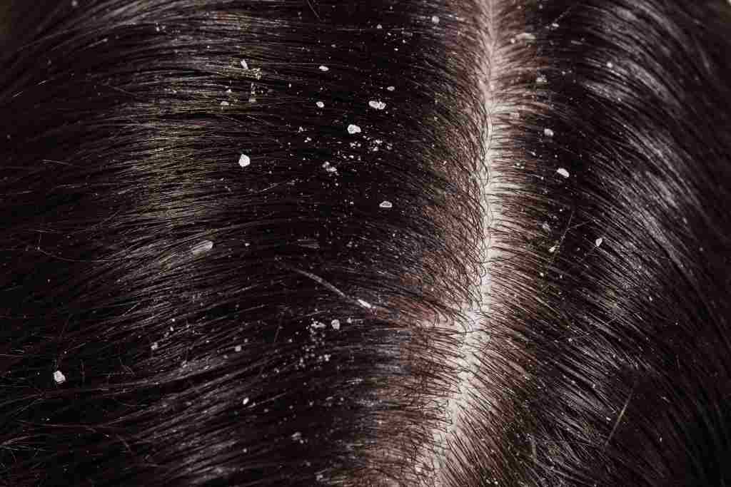 Rambut Rontok dan Gatal? Atasi Ketombe dengan 7 Tips Jitu Ini!