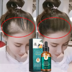 Rambut Kering dan Kusam? Ini Nutrisi yang Dibutuhkan untuk Kembalikan Keindahannya!