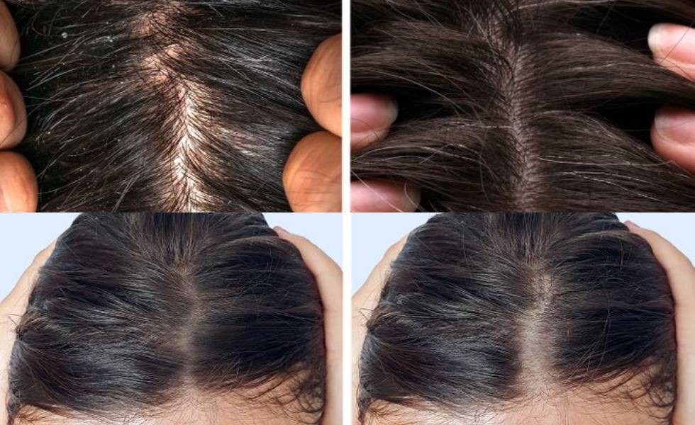 Bisakah Rambut Tipis Karena Keturunan Menjadi Tebal? Menyingkap Rahasia Rambut Lebat