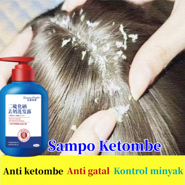 Ketombe Musuh Rambut Sehat Yang Bisa Diatasi