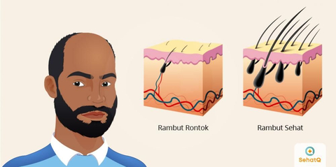 Rambutmu Tumbuh, Tapi Bagaimana Caranya?