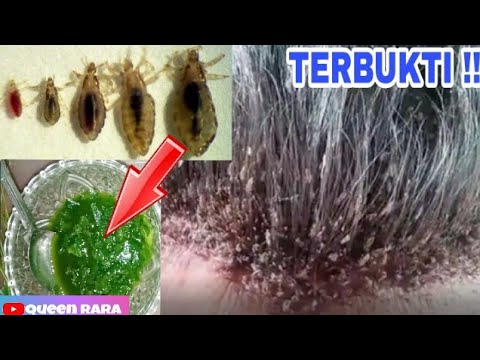 Ucapkan Selamat Tinggal pada Kutu Rambut dengan Lidah Buaya!