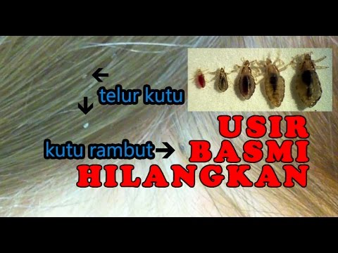 Cara Menghilangkan Kutu Rambut dengan Minyak Kelapa: Selamat Tinggal Kutu, Halo Rambut Sehat!