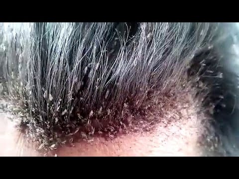 Atasi Gatal dan Ketombe dengan Minyak Kemiri: Cara Alami Menghilangkan Kutu Rambut