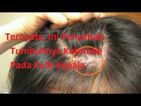 Ketombe Di Usia Senja: Penyebab dan Solusi untuk Kulit Kepala yang Sehat