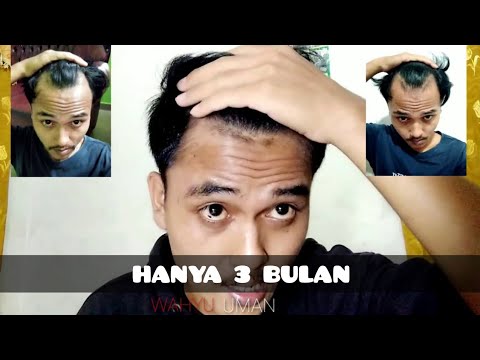 Ucapkan Selamat Tinggal pada Kebotakan: Panduan Lengkap Menumbuhkan Rambut Kembali