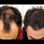 Ucapkan Selamat Tinggal pada Kebotakan: Panduan Lengkap Menumbuhkan Rambut Kembali