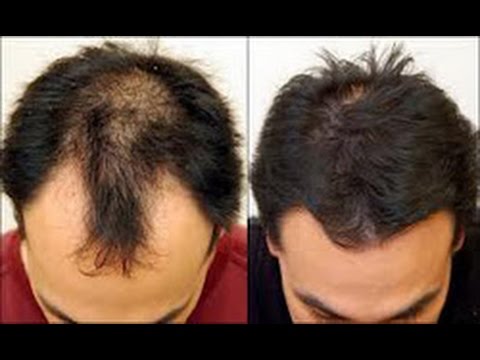 Ucapkan Selamat Tinggal pada Kebotakan: Panduan Lengkap Menumbuhkan Rambut Kembali