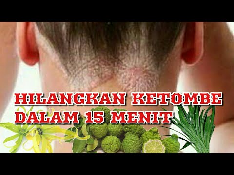 Perpisahan dengan Ketombe: Kisah Perjuangan Mengatasi Kulit Kepala Kering dengan Bahan Alami