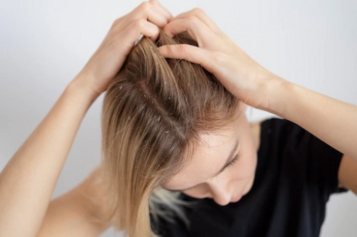 Rahasia Rambut Bebas Ketombe dengan Perawatan Alami