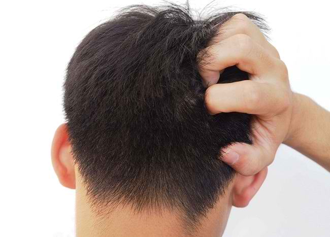 Bagaimana Kutu Rambut Terjadi: Mitos dan Fakta yang Perlu Anda Ketahui