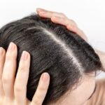 Perangi Ketombe Parah dengan Cepat: 7 Tips Jitu Untuk Rambut Sehat dan Bersih