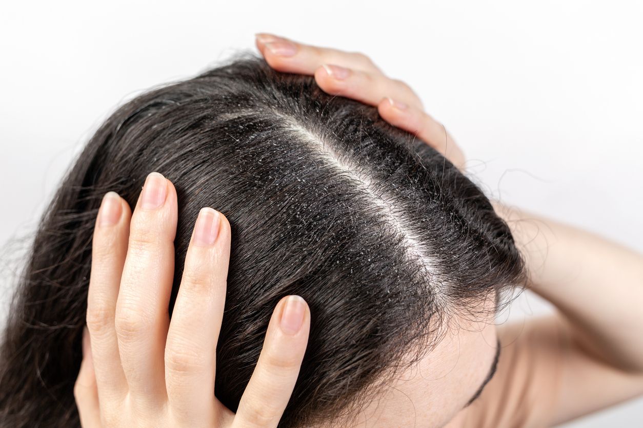 Perangi Ketombe Parah dengan Cepat: 7 Tips Jitu Untuk Rambut Sehat dan Bersih