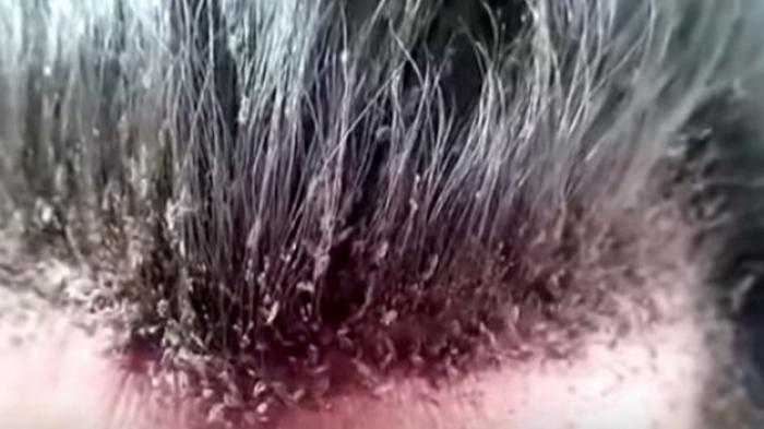 Cara Menghilangkan Kutu Rambut dengan Minyak Serai: Solusi Alami yang Ampuh!