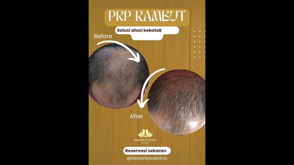 Nutrisi Apa yang Dibutuhkan Rambut untuk Mencegah Kebotakan?