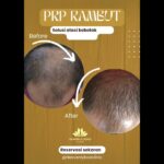 Nutrisi Apa yang Dibutuhkan Rambut untuk Mencegah Kebotakan?