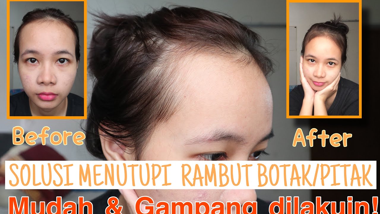 Rambutmu Berketombe? Hati-hati, Bisa Jadi Produk Perawatanmu yang Bermasalah!