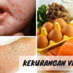 Rambut Rontok Tak Terkendali? Mungkin Kekurangan Vitamin!