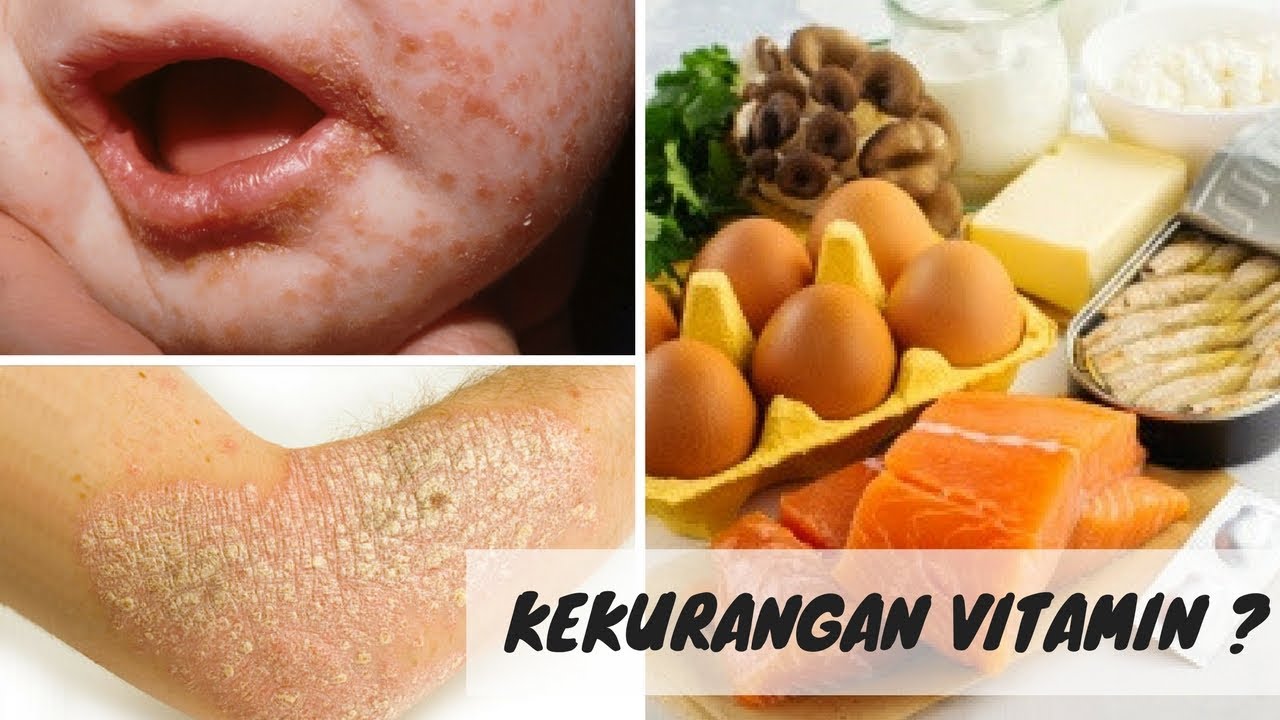 Rambut Rontok Tak Terkendali? Mungkin Kekurangan Vitamin!