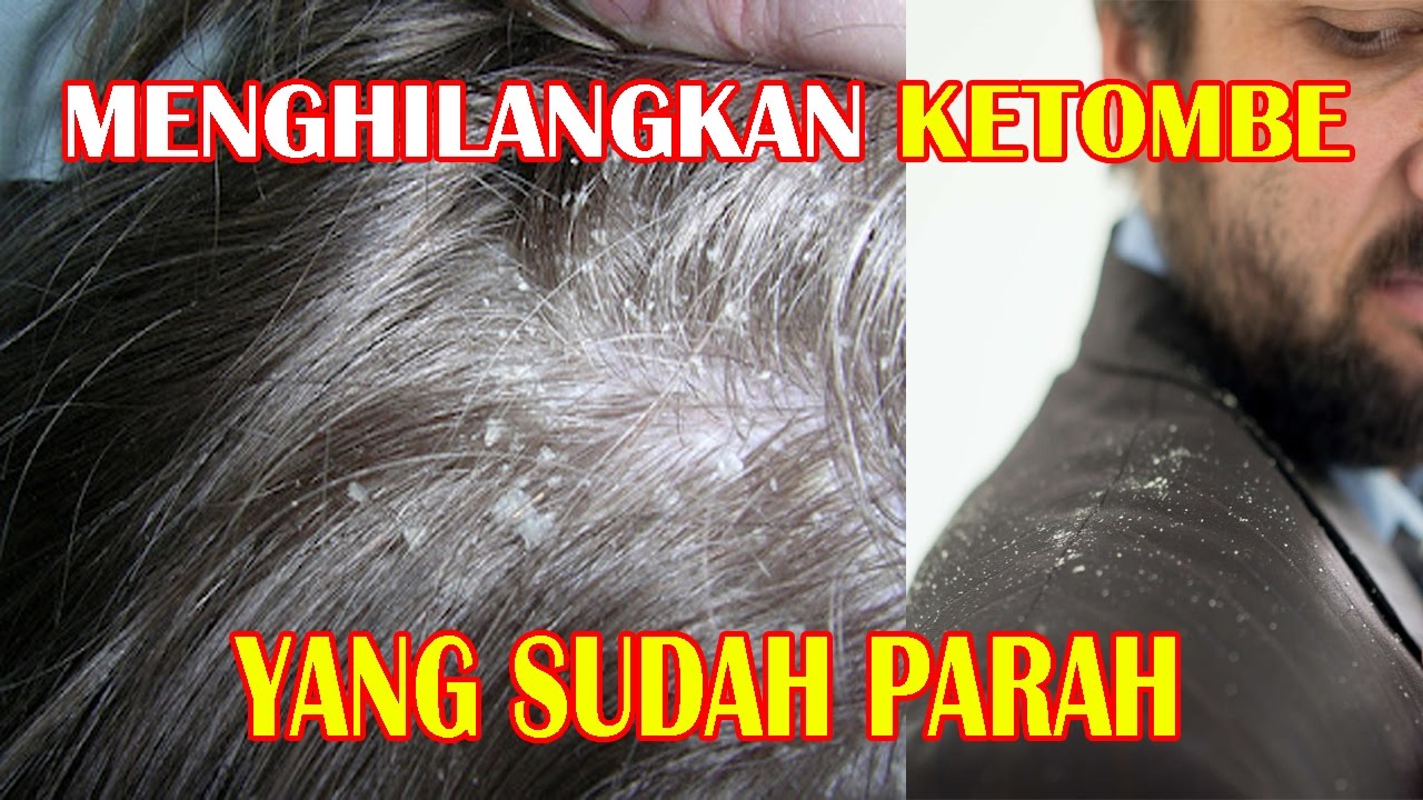 Perangi Ketombe Parah dengan Cepat: 7 Tips Jitu Untuk Rambut Sehat dan Bersih