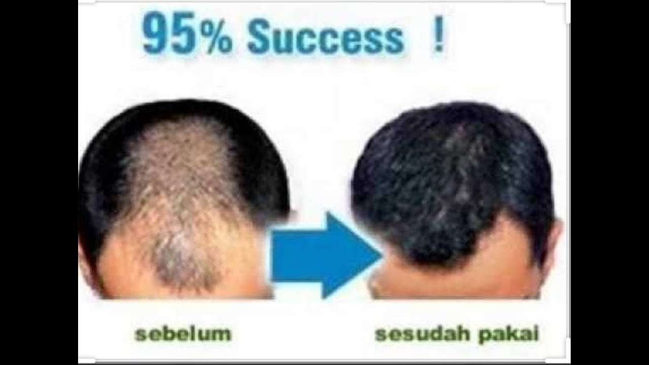 Rahasia Rambut Sehat dan Berkilau: Nutrisi Alami untuk Rambut Impianmu