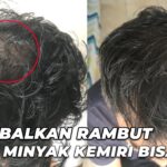 Apakah Minyak Esensial Efektif untuk Rambut Rontok?