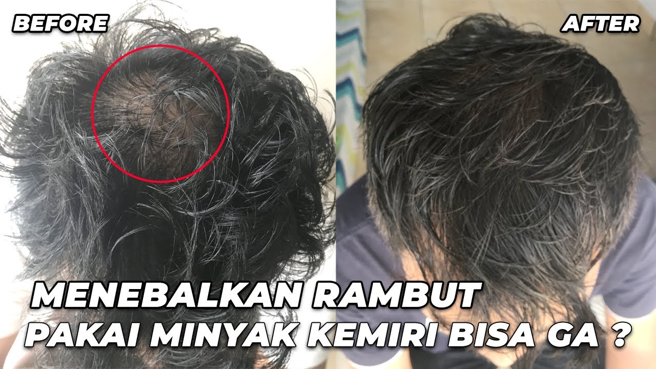 Apakah Minyak Esensial Efektif untuk Rambut Rontok?