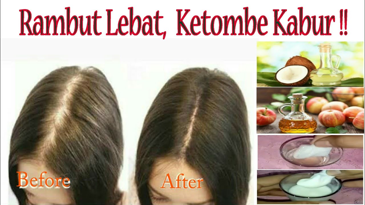 Berjuang Melawan Ketombe di Rambut Lurus? Solusi Alami yang Ampuh!