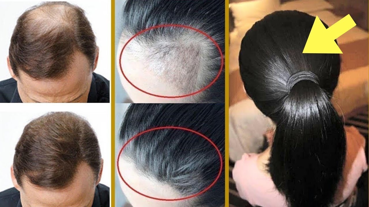 Rahasia Rambut Lebat dan Sehat: Nutrisi yang Tepat untuk Rambut Impianmu