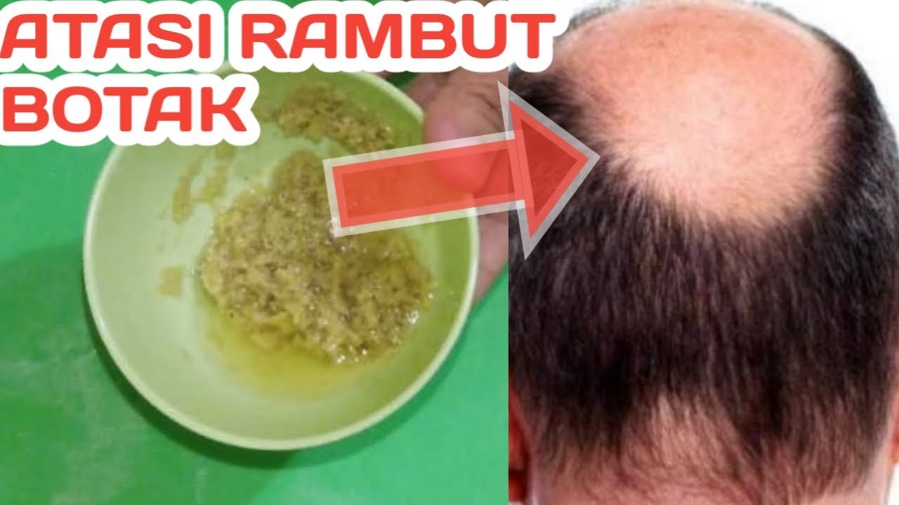 Apakah Rambut yang Botak Bisa Tumbuh Kembali? Sebuah Panduan Lengkap