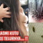 Menghilangkan Telur Kutu: Panduan Lengkap untuk Rambut Bebas Kutu