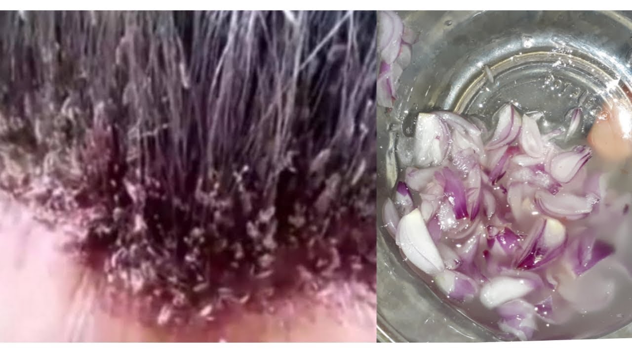 Gatal Tak Tertahankan? Begini Cara Menghilangkan Kutu di Rambut!