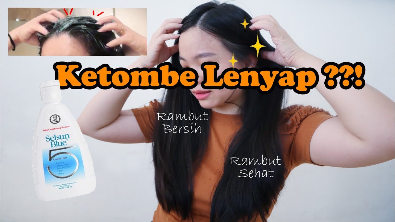 Mengapa Ketombe Tak Kunjung Hilang Walau Sudah Ganti Shampoo?