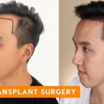 Kehilangan Rambut? Transplantasi Rambut Bisa Jadi Solusinya!