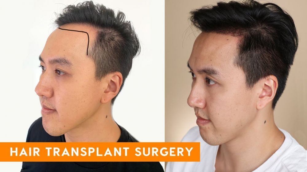 Kehilangan Rambut? Transplantasi Rambut Bisa Jadi Solusinya!